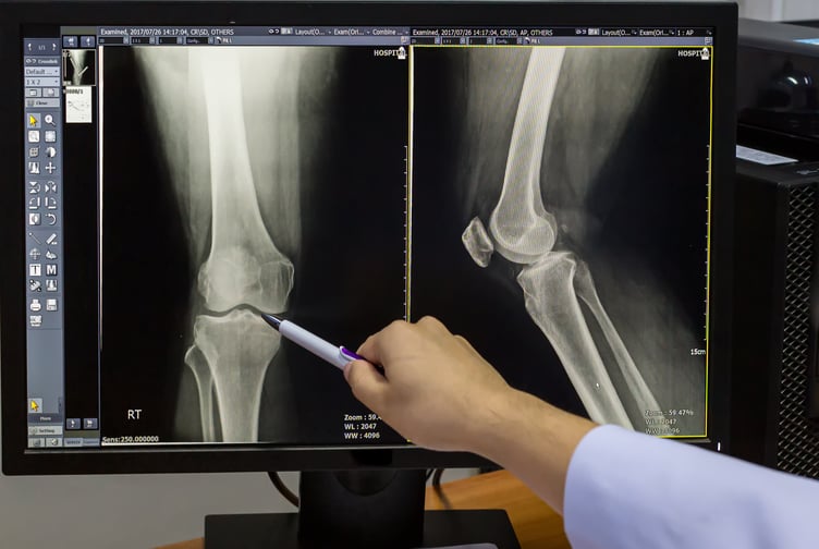 X-Ray of knee
