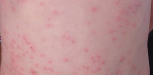 Drop-in for your MMR vaccine
